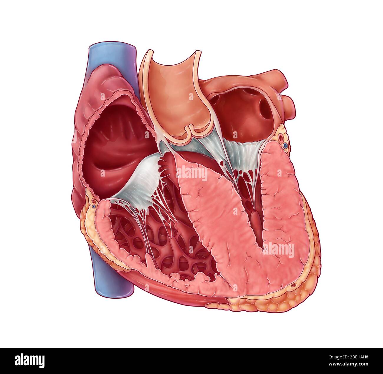 Cardiomiopatia ipertrofica Foto Stock