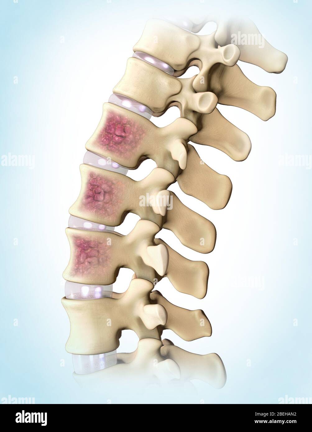 Mieloma multiplo, colonna vertebrale Foto Stock