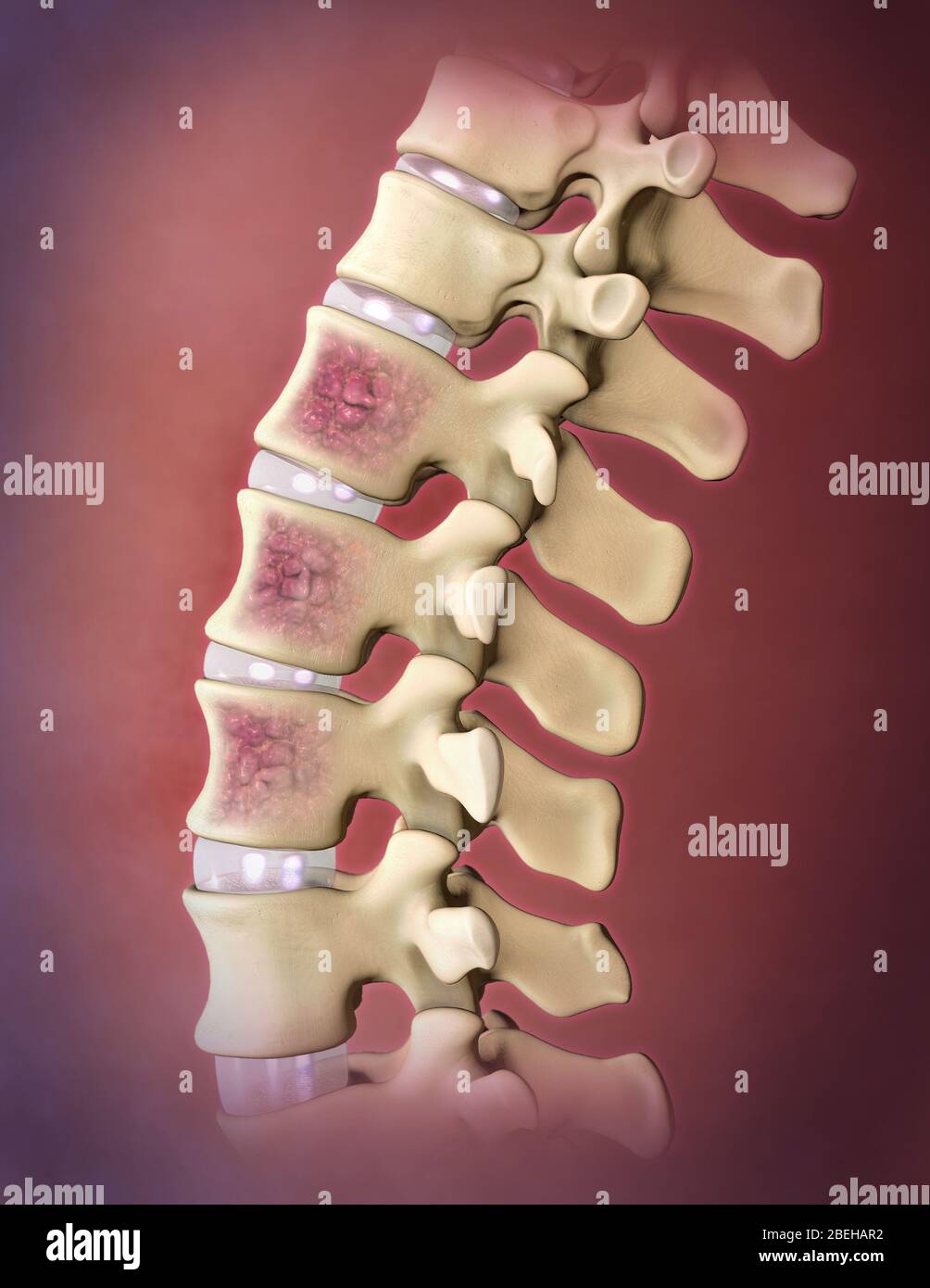 Mieloma multiplo, colonna vertebrale Foto Stock