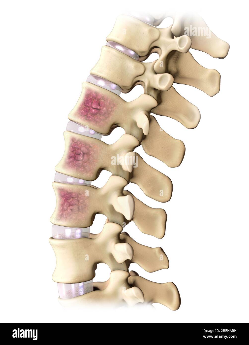 Mieloma multiplo, colonna vertebrale Foto Stock