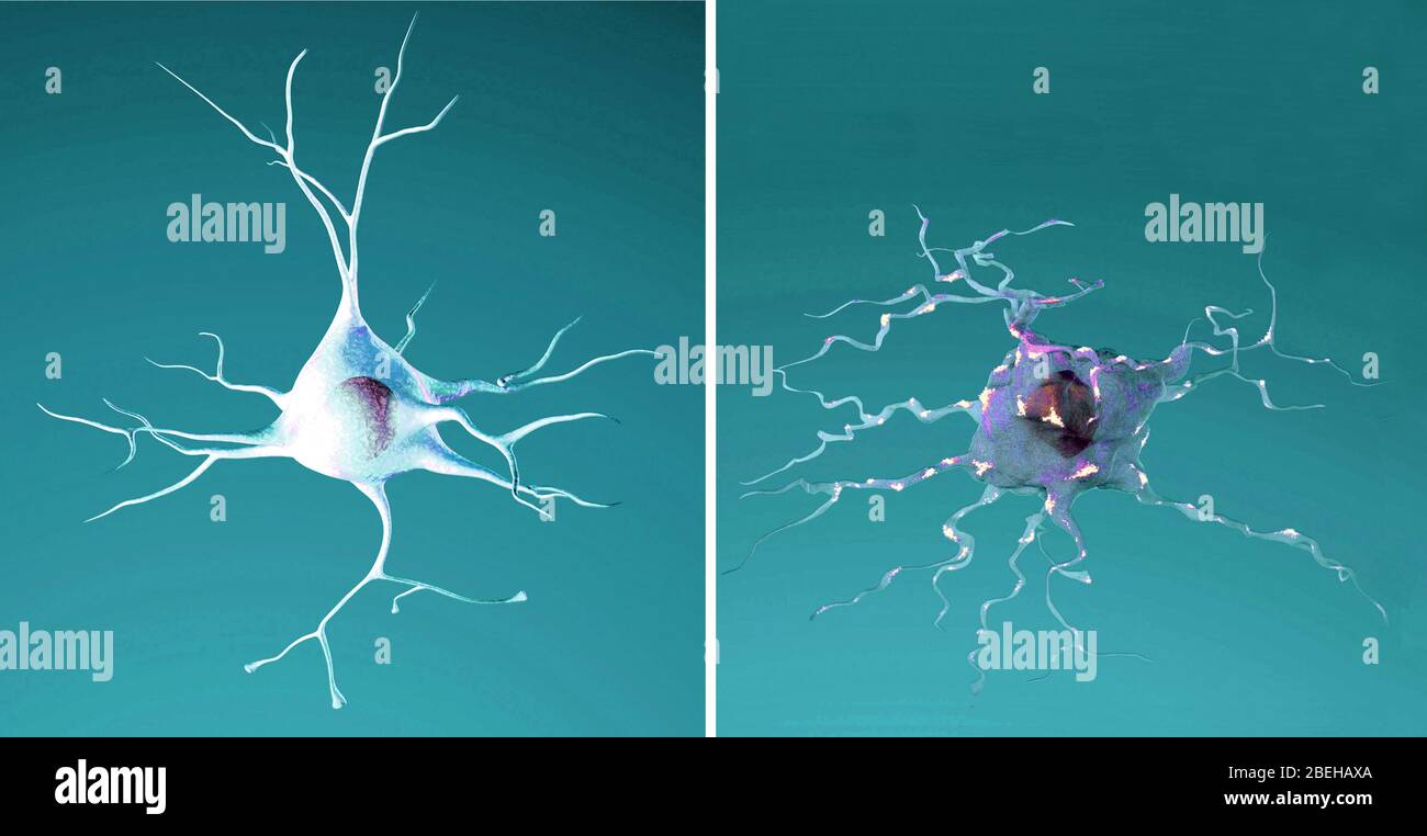 Neurone normale e morente, morbo di Alzheimer Foto Stock