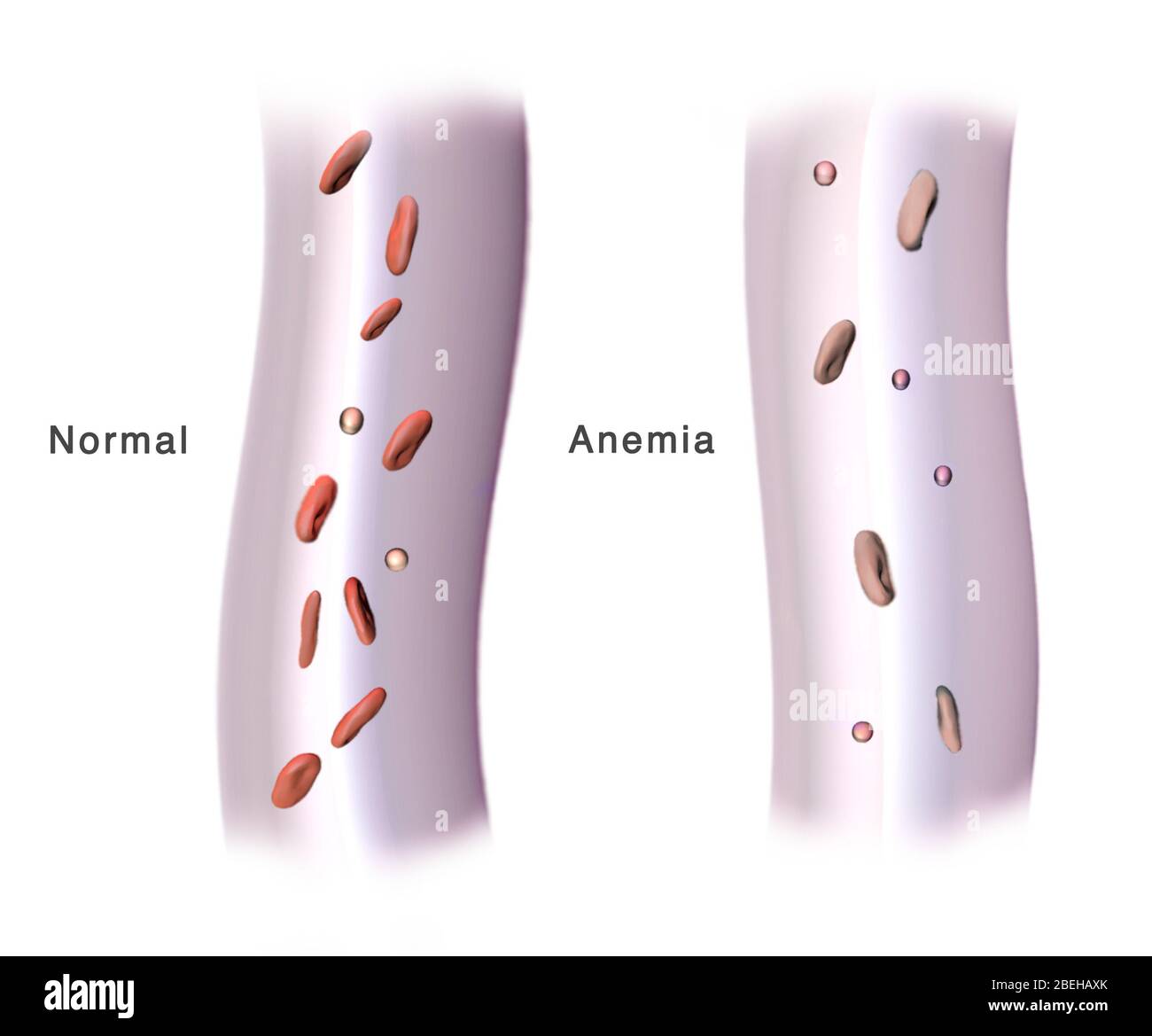 Globuli rossi e anemia, illustrazione Foto Stock