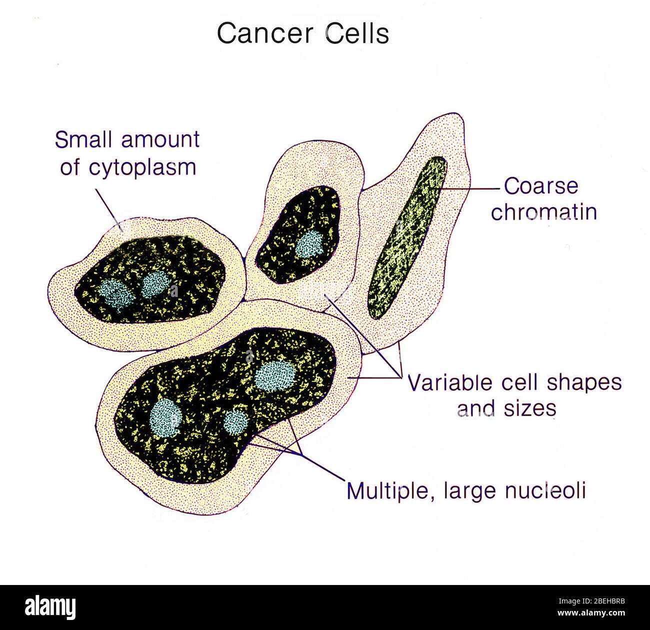 Cellule tumorali, illustrazione Foto Stock