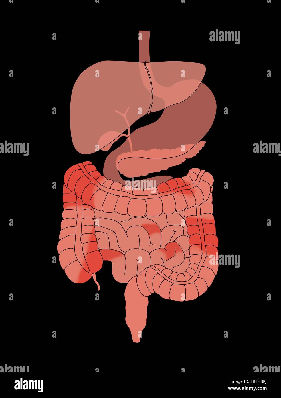 Morbo di Crohn Foto Stock