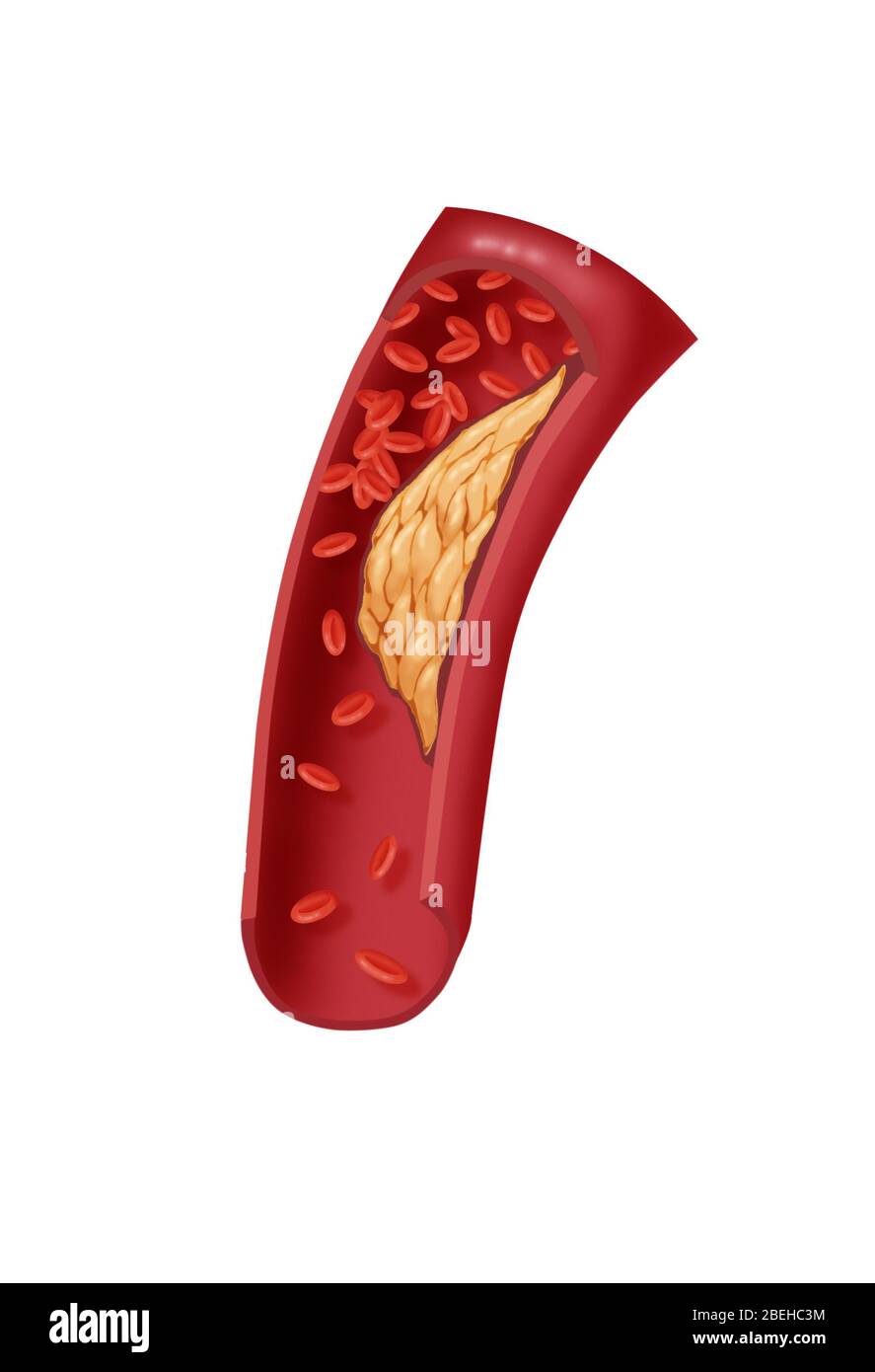 Arteriosclerotico Malattia coronarica Foto Stock