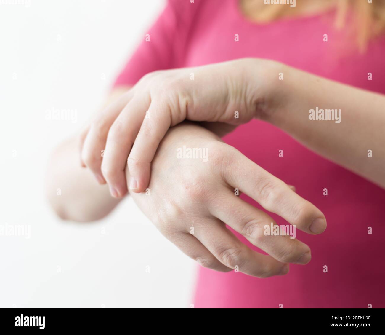 Giovane donna o ragazza con malattia da artrite reumatoide deformata dita e mani. Foto Stock