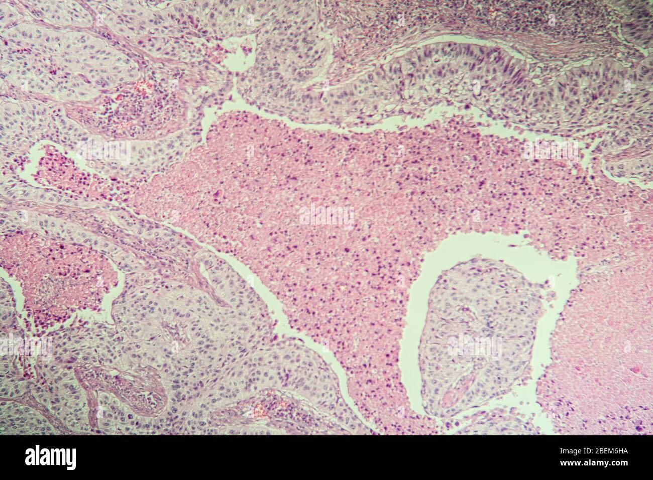 Carcinoma a cellule squamose tessuto malato al microscopio 100x Foto Stock