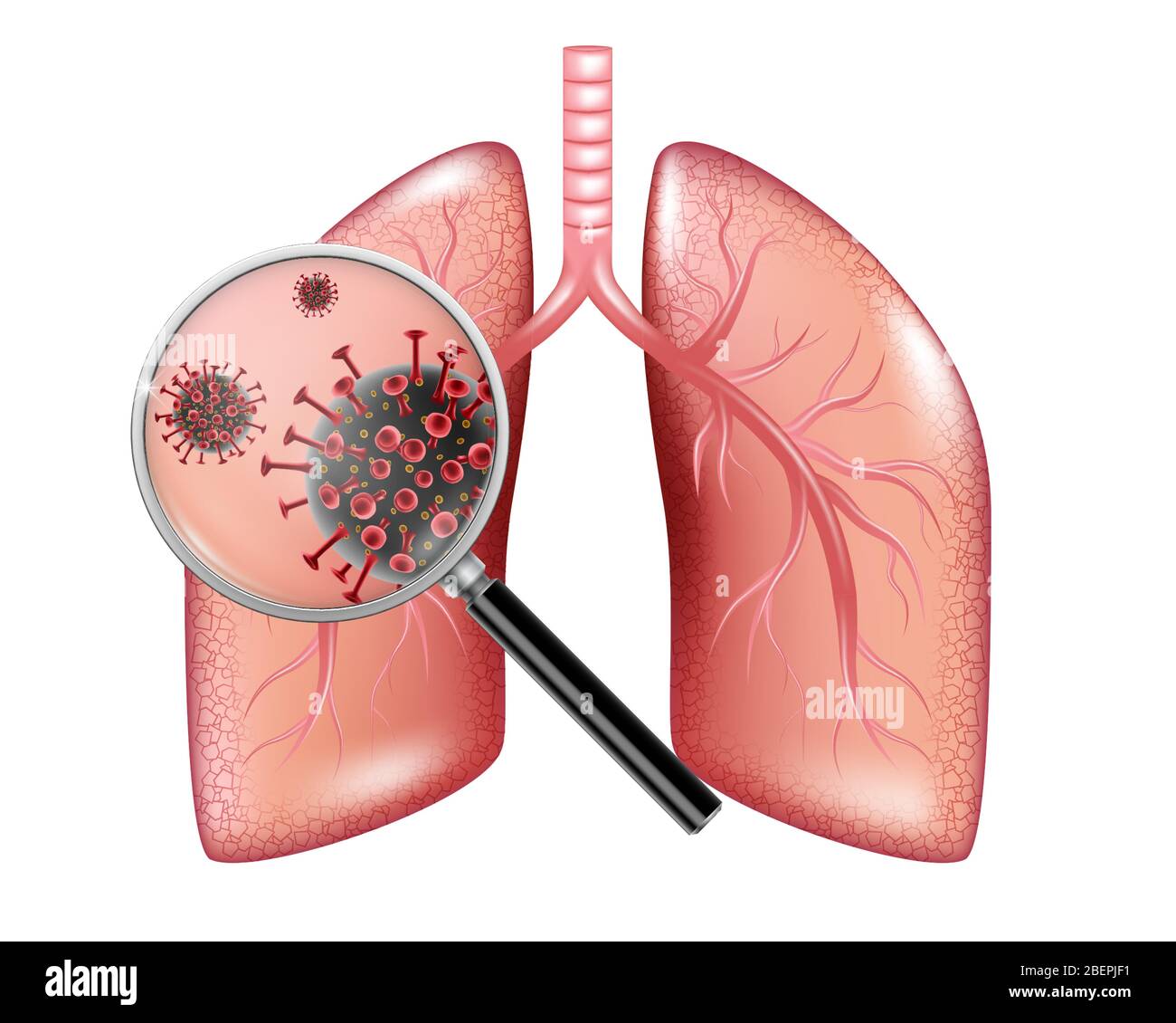 Epidemia realistica del virus Corona. Striscione di coronavirus con polmoni infetti e lente di ingrandimento isolata su bianco. Vettore Illustrazione Vettoriale Epidemia realistica del virus Corona. Striscione di coronavirus con polmoni infetti e lente di ingrandimento isolata su bianco. Vettore Illustrazione Vettoriale