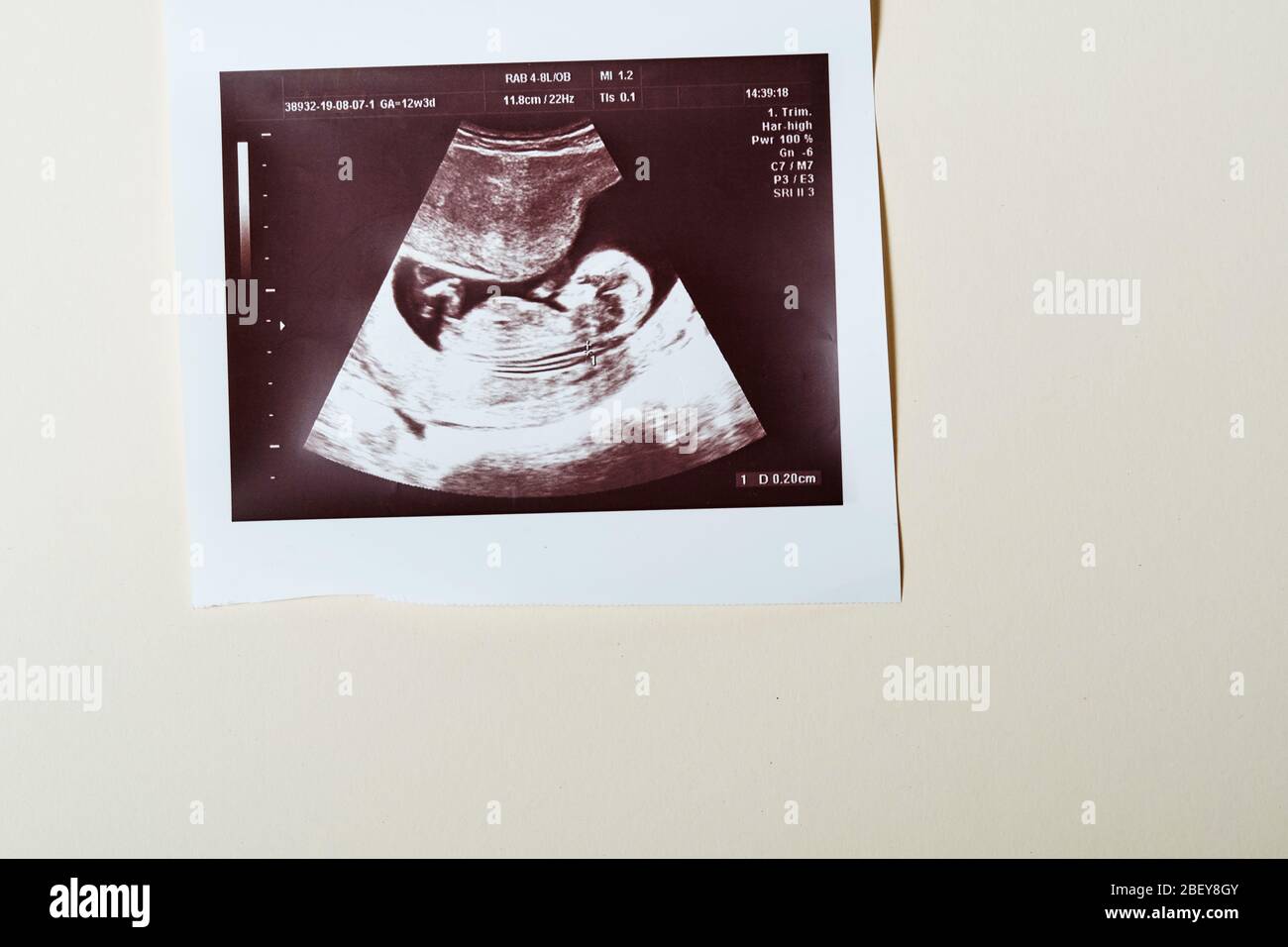 Embrione A 5 Settimane Immagini E Fotos Stock Alamy