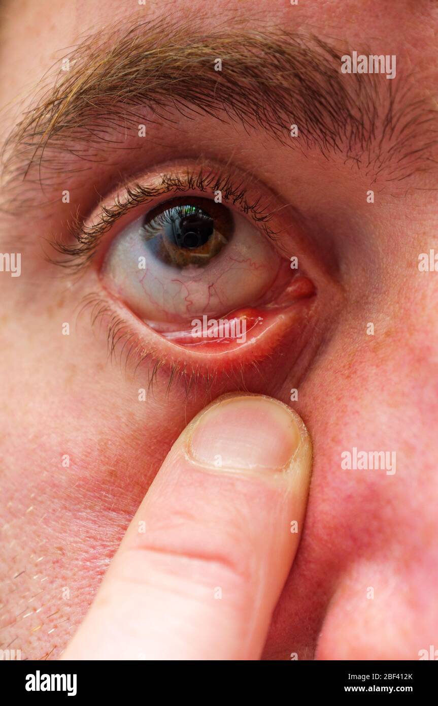 Closeup macro uomo con infezione batterica dell'occhio di porco di porco di  stie hordeolum all'interno della palpebra Foto stock - Alamy