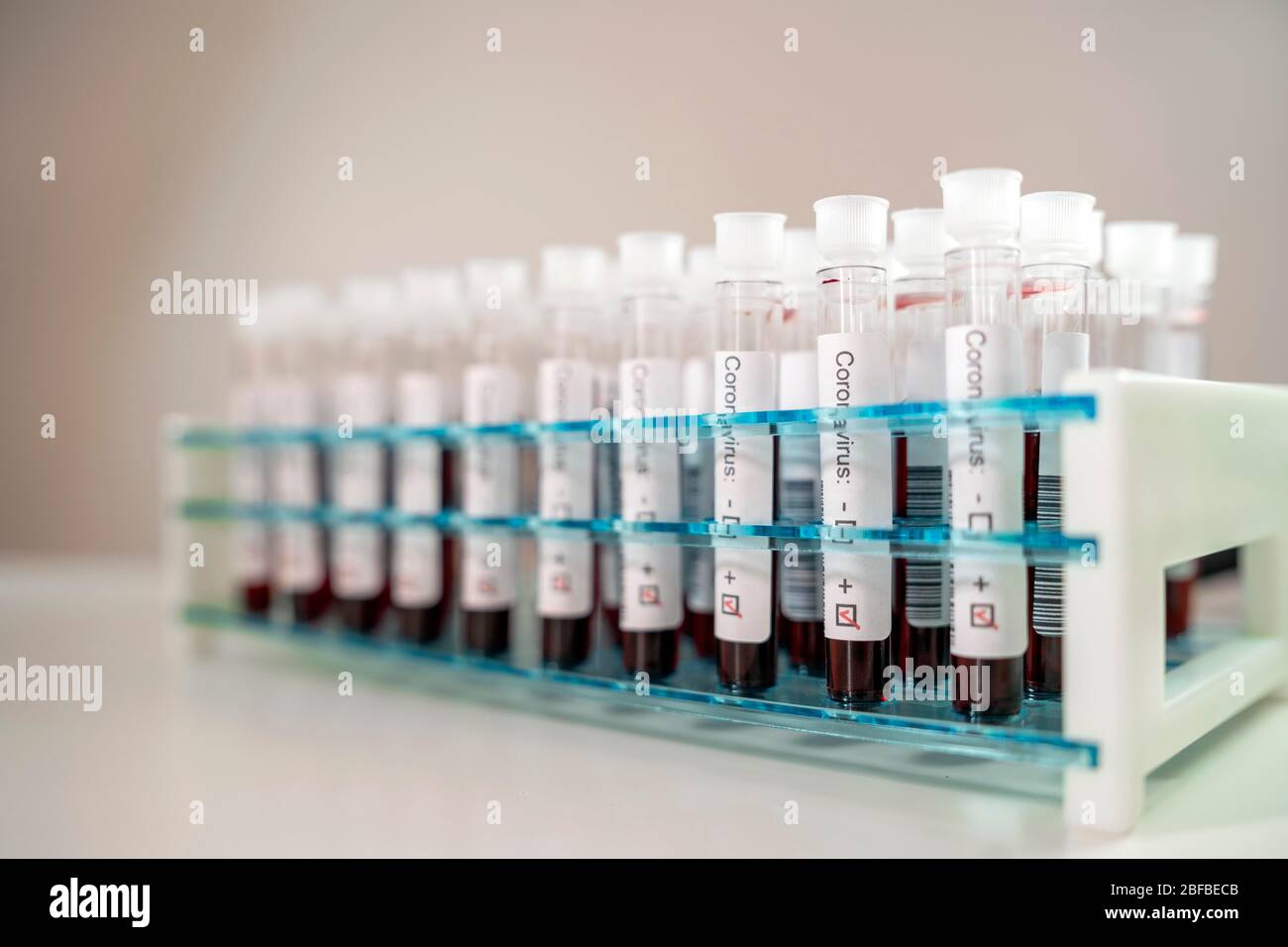 Risultati positivi dei test del virus corona, molte provette per analisi del sangue in supporto in laboratorio, Germania Foto Stock