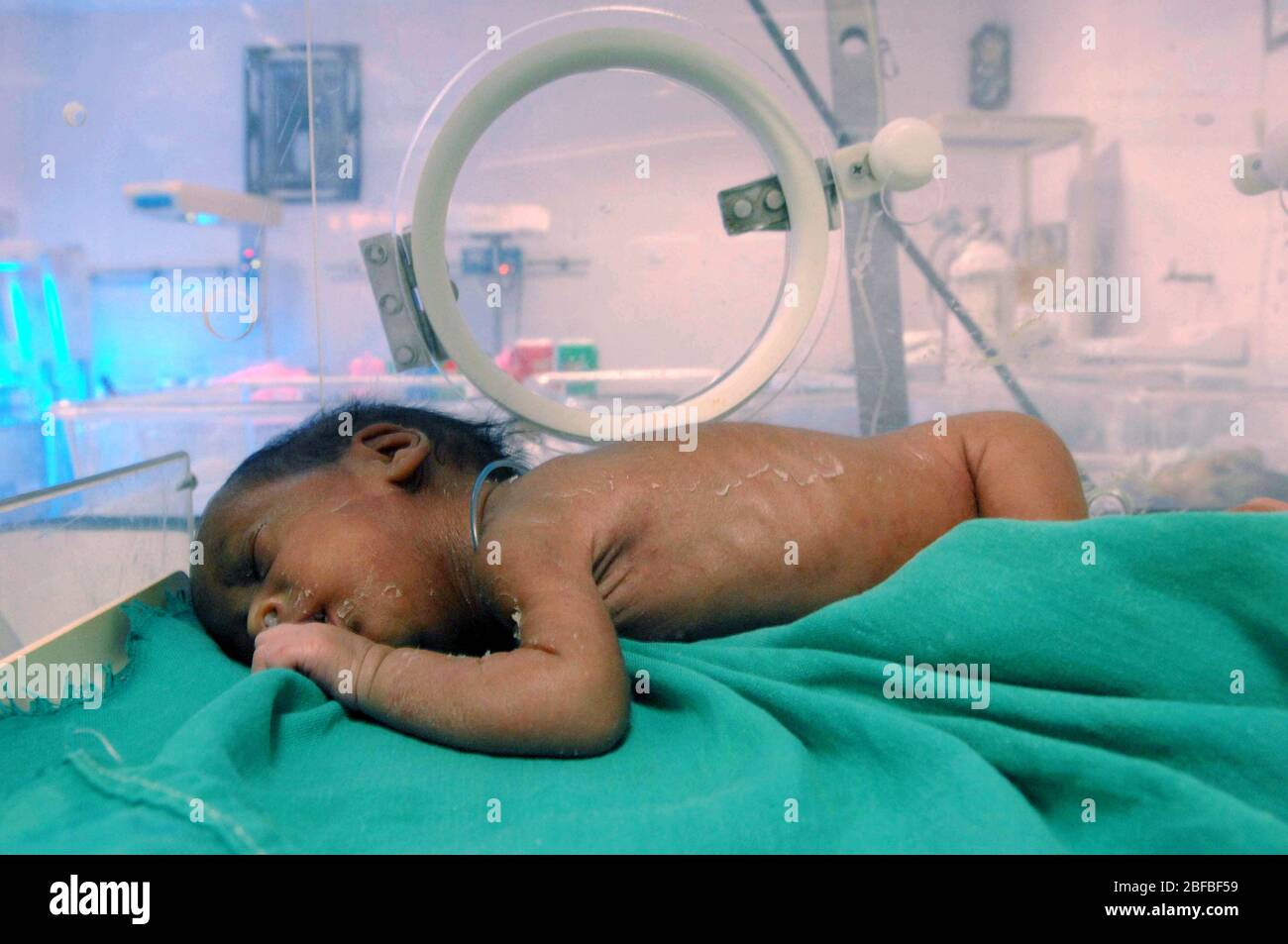 Un bambino prematuro si trova in un incubatore. Ogni bambino nato prima di 37  settimane di