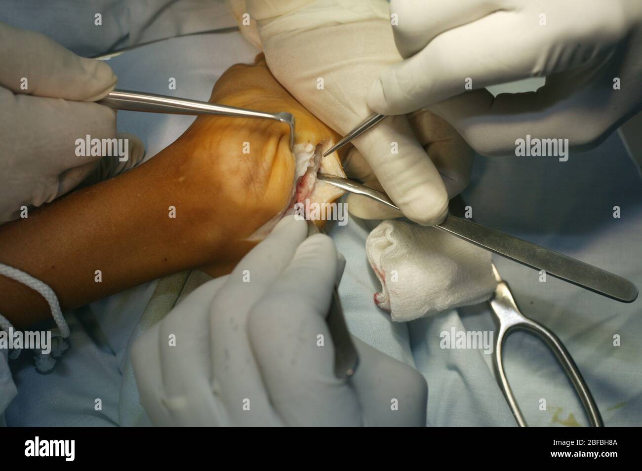 I chirurghi espongono inoltre i tendini peroneo-brevis e peroneo-longus dal tessuto molle circostante. Foto Stock