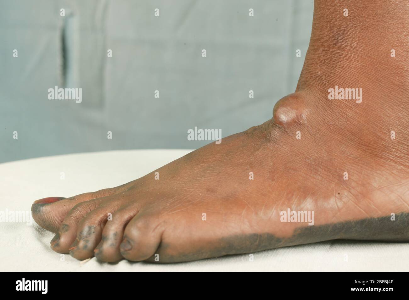 Un paitent con una cisti sebacea sul loro piede. Le cisti sebacee sono cisti non cancerose comuni della pelle. Le cisti sono anomalie nel corpo che ma Foto Stock