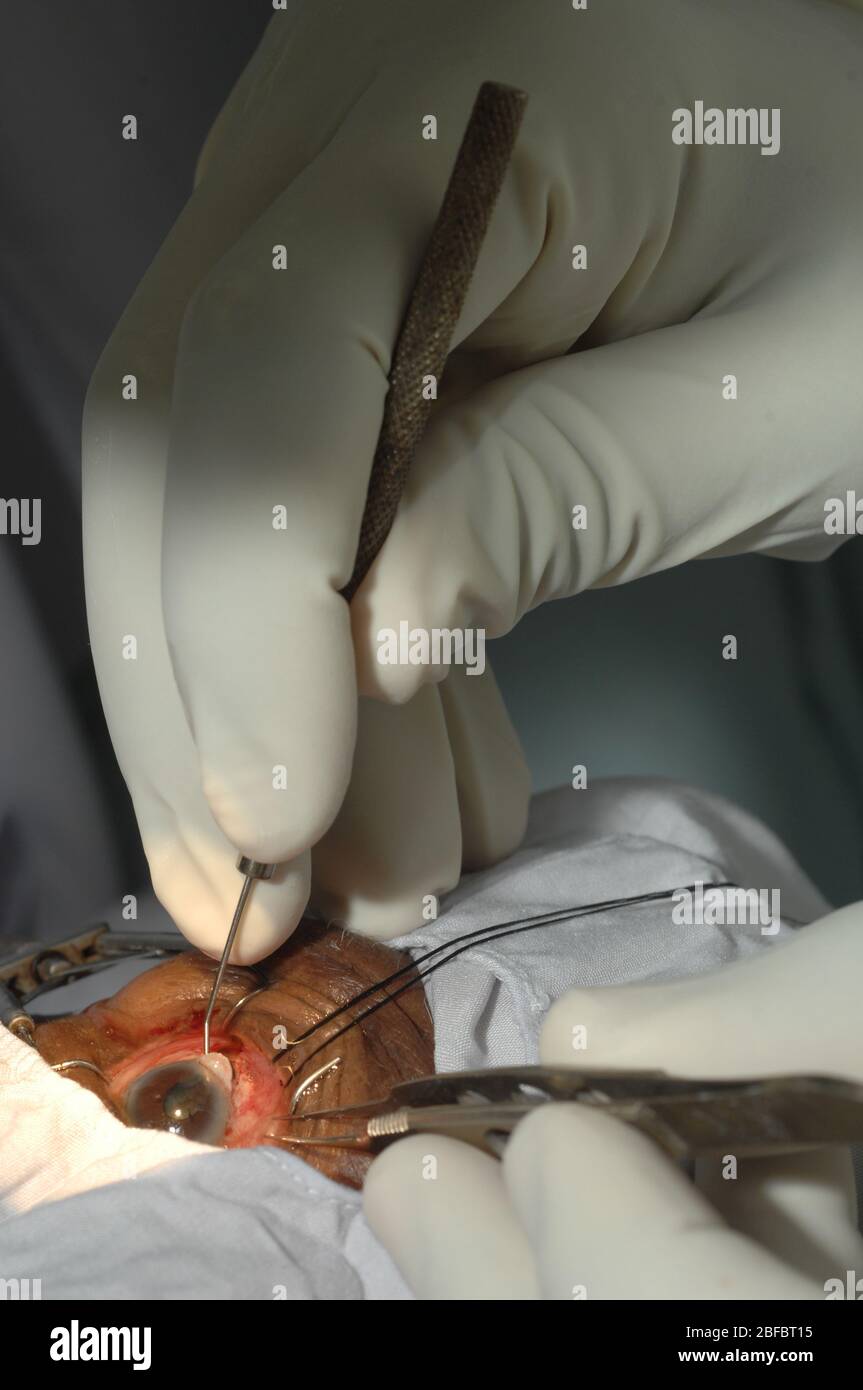 Il chirurgo sta tenendo una spatola dell'iride. Questo è un piccolo strumento utilizzato per rompere il nucleo, che rende più facile il processo di rimozione con phacoemu Foto Stock