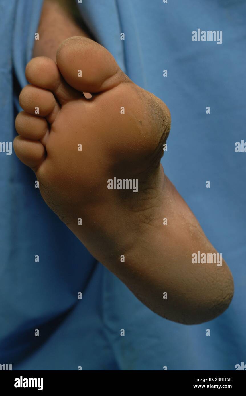 Micetoma sulla gamba sinistra di un paziente. Il micetoma è una malattia non comune riscontrata nei tropici. È un'infezione cronica localizzata della pelle e dell'unde Foto Stock