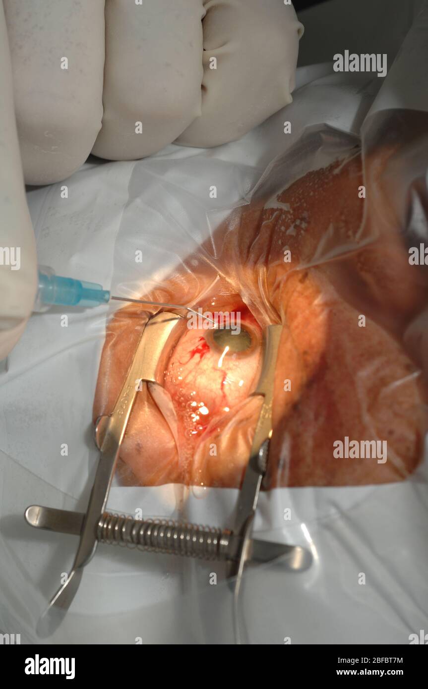 Viene quindi eseguita l'idrodissezione delle adesioni tra la corteccia della lente e la capsula anteriore. La soluzione salina viene iniettata attraverso l'ago, whic Foto Stock