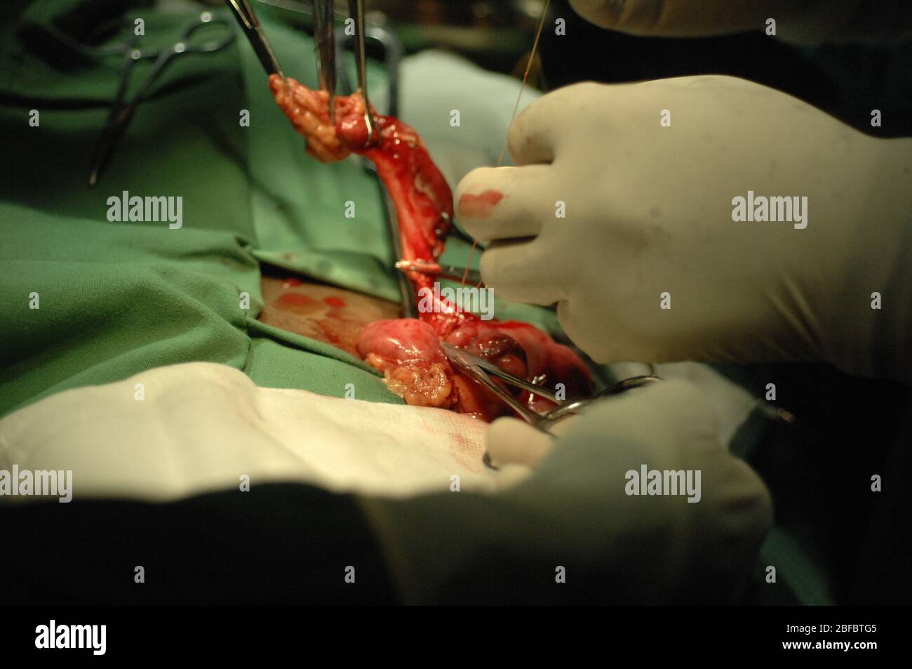 Una sutura seromuscolare a filo di porpora è posta nel ceco con una sutura assorbibile. Le pinze emostatiche utilizzate per bloccare il sangue mesenterico Foto Stock