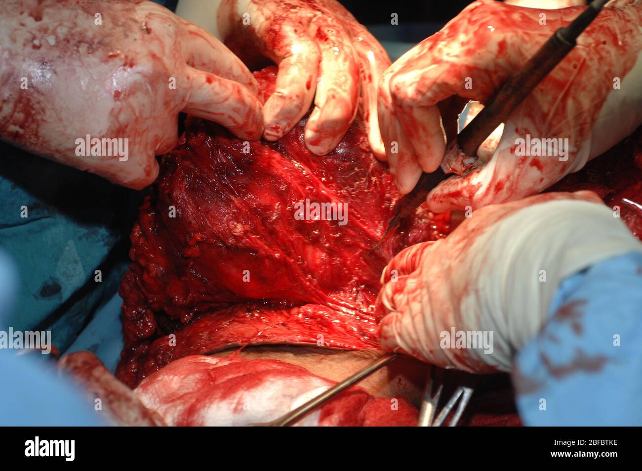 Nella foto è raffigurato un uomo sottoposto a chirurgia per rimuovere il fibrosarcoma. Il fibrosarcoma (sarcoma fibroblastico) è un tumore mesenchimale maligno derivato dal fibrou Foto Stock