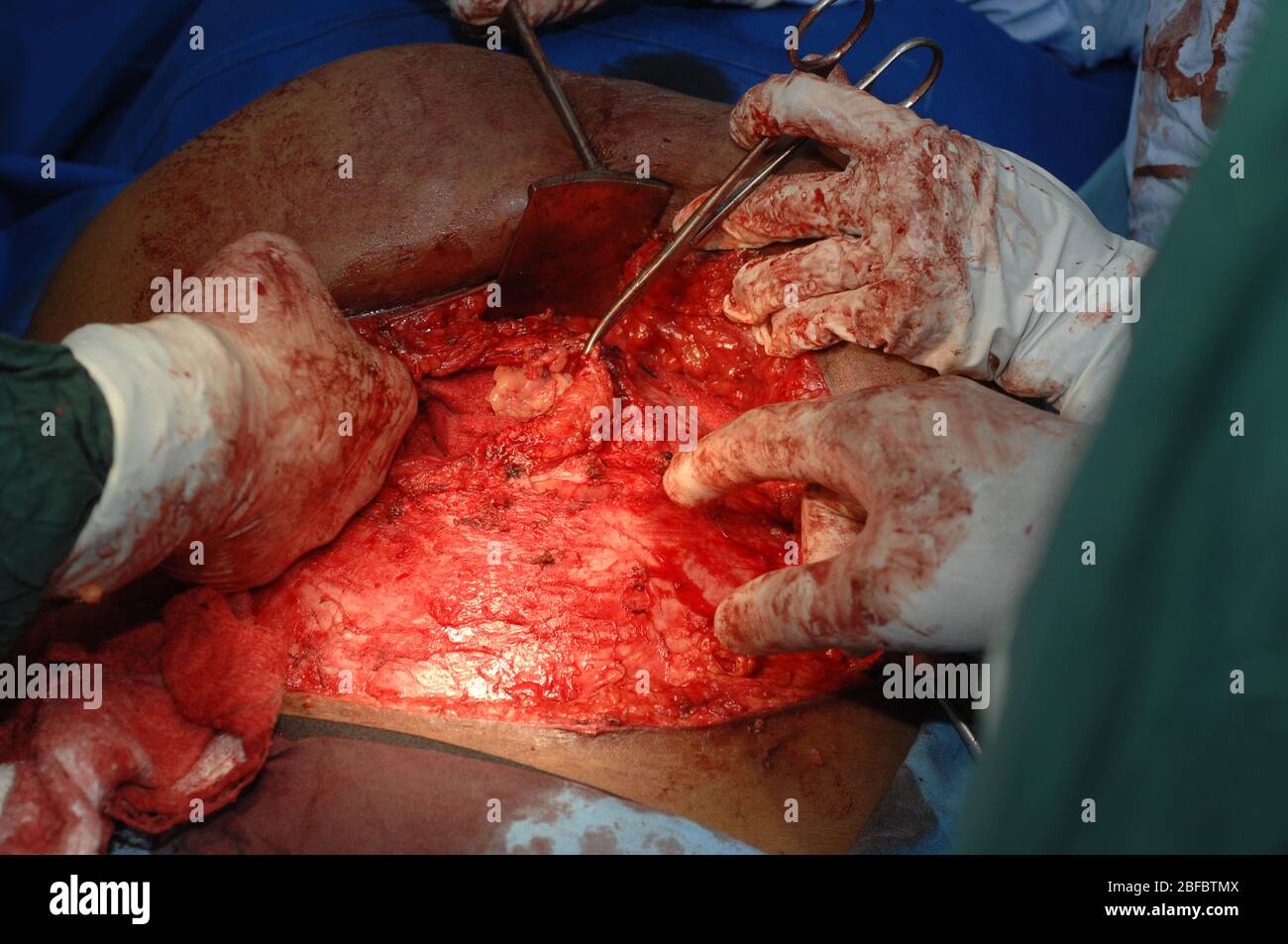 L'immagine mostra l'intervento di abdominoplastica o 'Tummy Tuck'. L'abdominoplastica o 'Tummy Tuck' è una procedura di chirurgia estetica utilizzata per rendere l'addome sottile Foto Stock