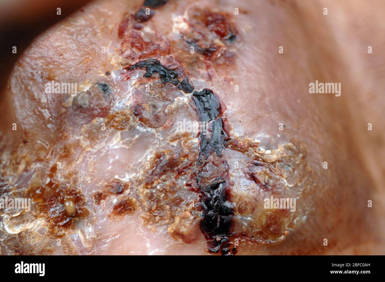 Eumycetoma al piede destro di un maschio di 35 anni. Il micetoma è una malattia non comune riscontrata nei tropici. È un'infezione cronica localizzata del Foto Stock