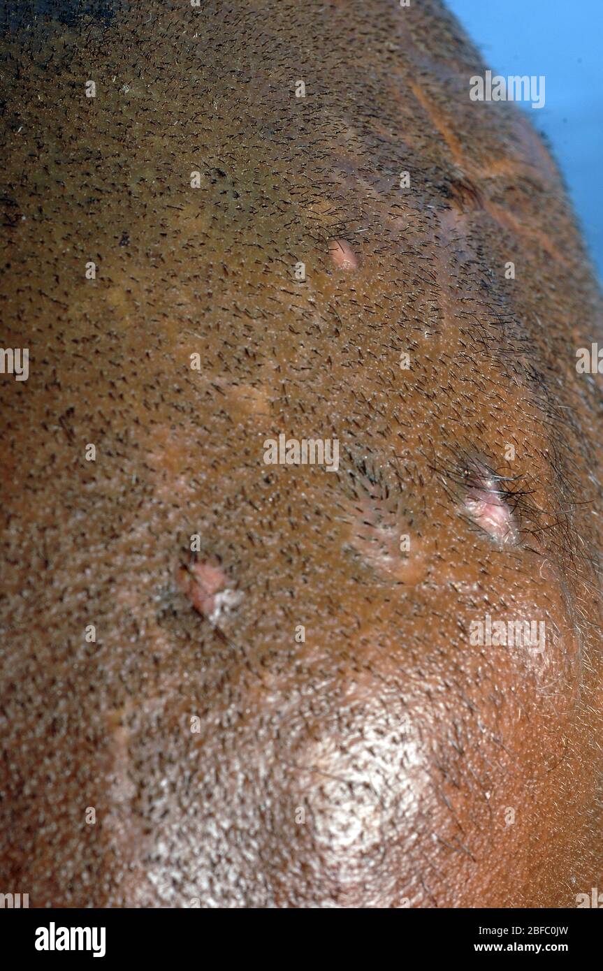 Actinomicetoma sulla testa di un maschio di 36 anni. Il micetoma è una malattia non comune riscontrata nei tropici. È un'infezione cronica localizzata della Foto Stock