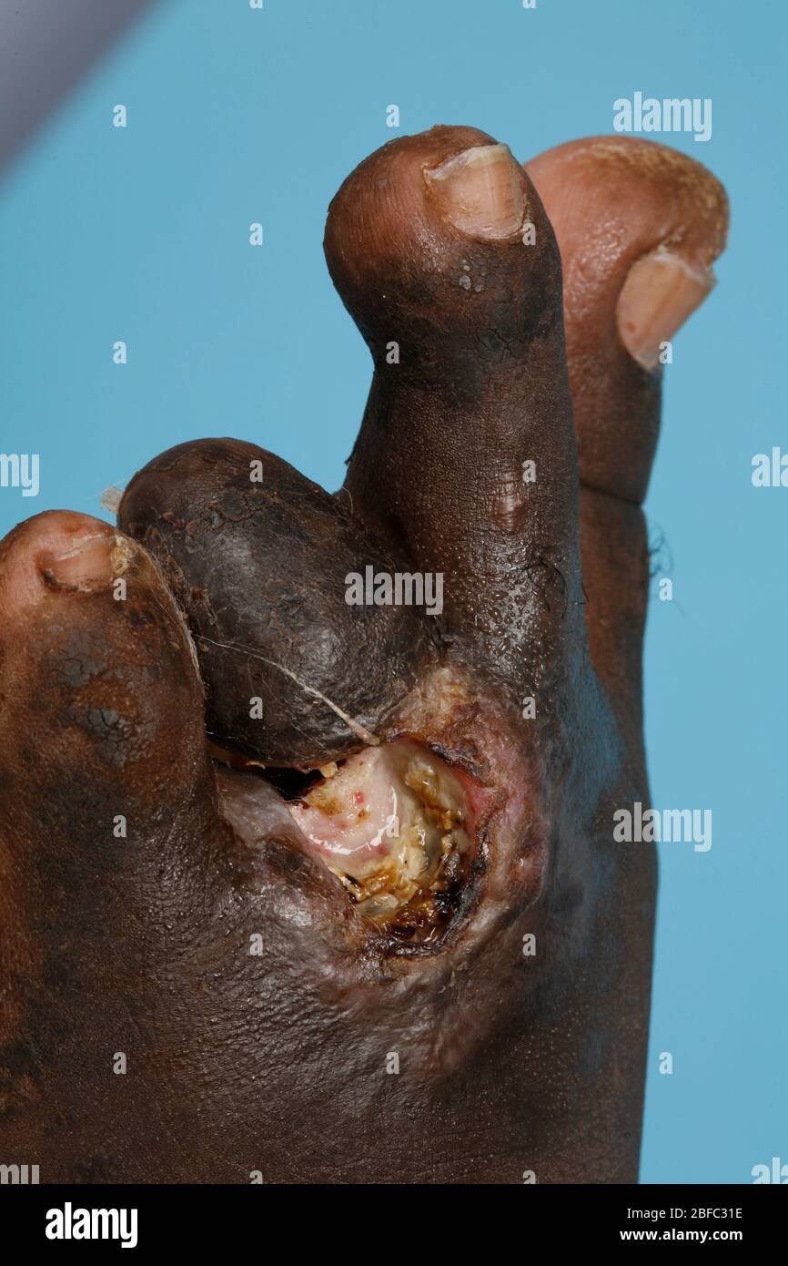 Primo piano del piede di un micetoma sufferer. Si noti che un dito del piede è stato precedentemente amputato per evitare che la malattia si diffonda di micetoma Foto Stock