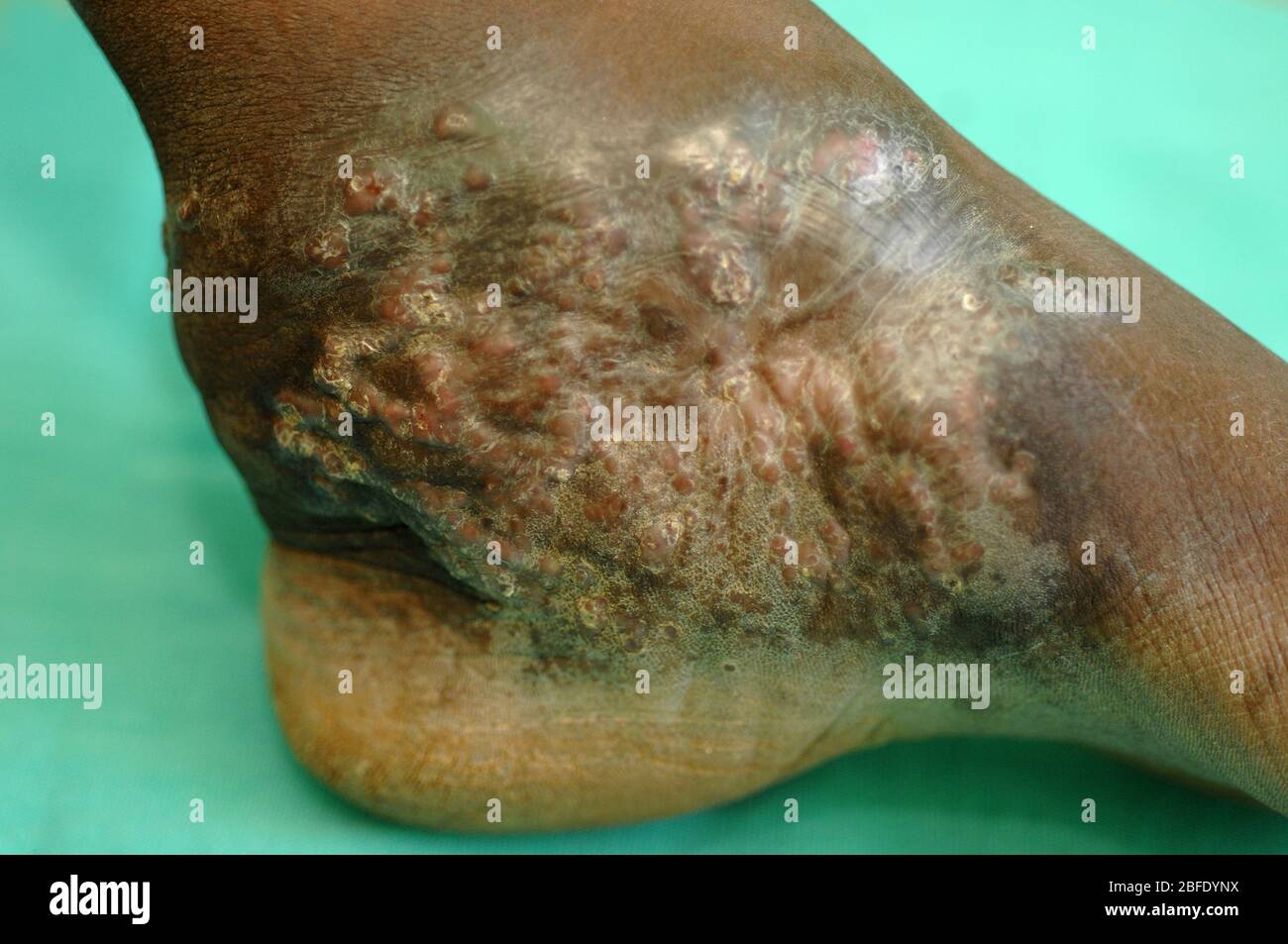 Actinomicetoma che colpisce la caviglia di un uomo anziano. Il micetoma è una malattia non comune riscontrata nei tropici. È un'infezione cronica localizzata di t Foto Stock