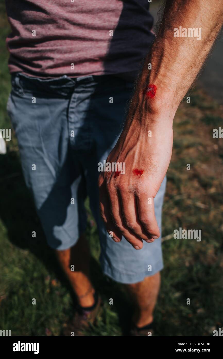 abrasione sulla mano maschile dopo un incidente di skateboard Foto Stock