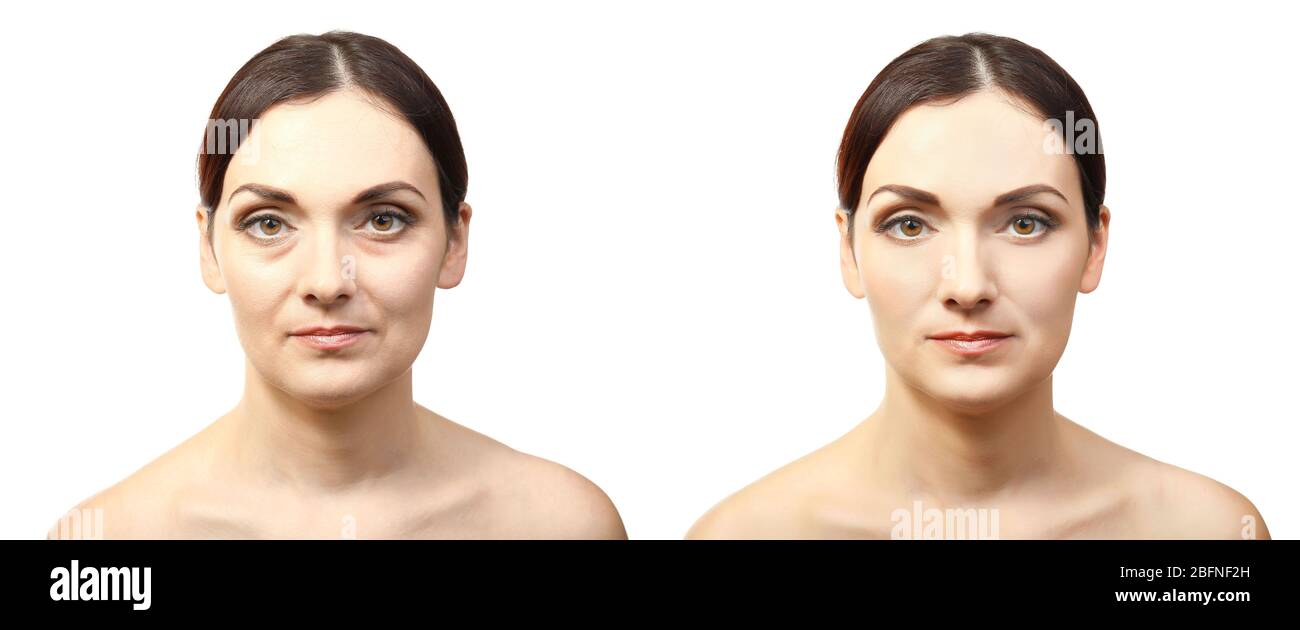 Faccia della donna prima e dopo la procedura cosmetica. Concetto di chirurgia plastica. Foto Stock