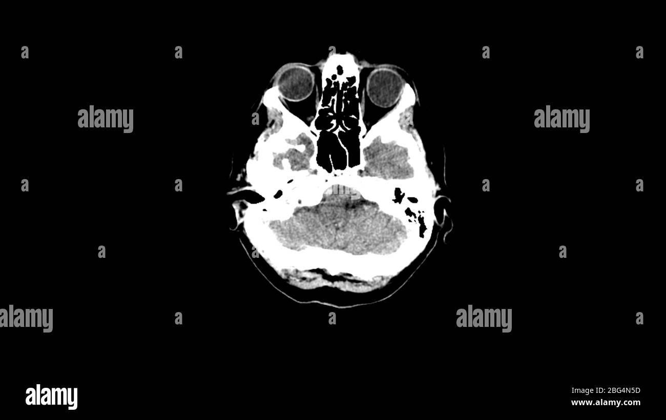Scansione MRI del cervello con ematoma. Scansione di imaging con risonanza magnetica reale. Foto Stock