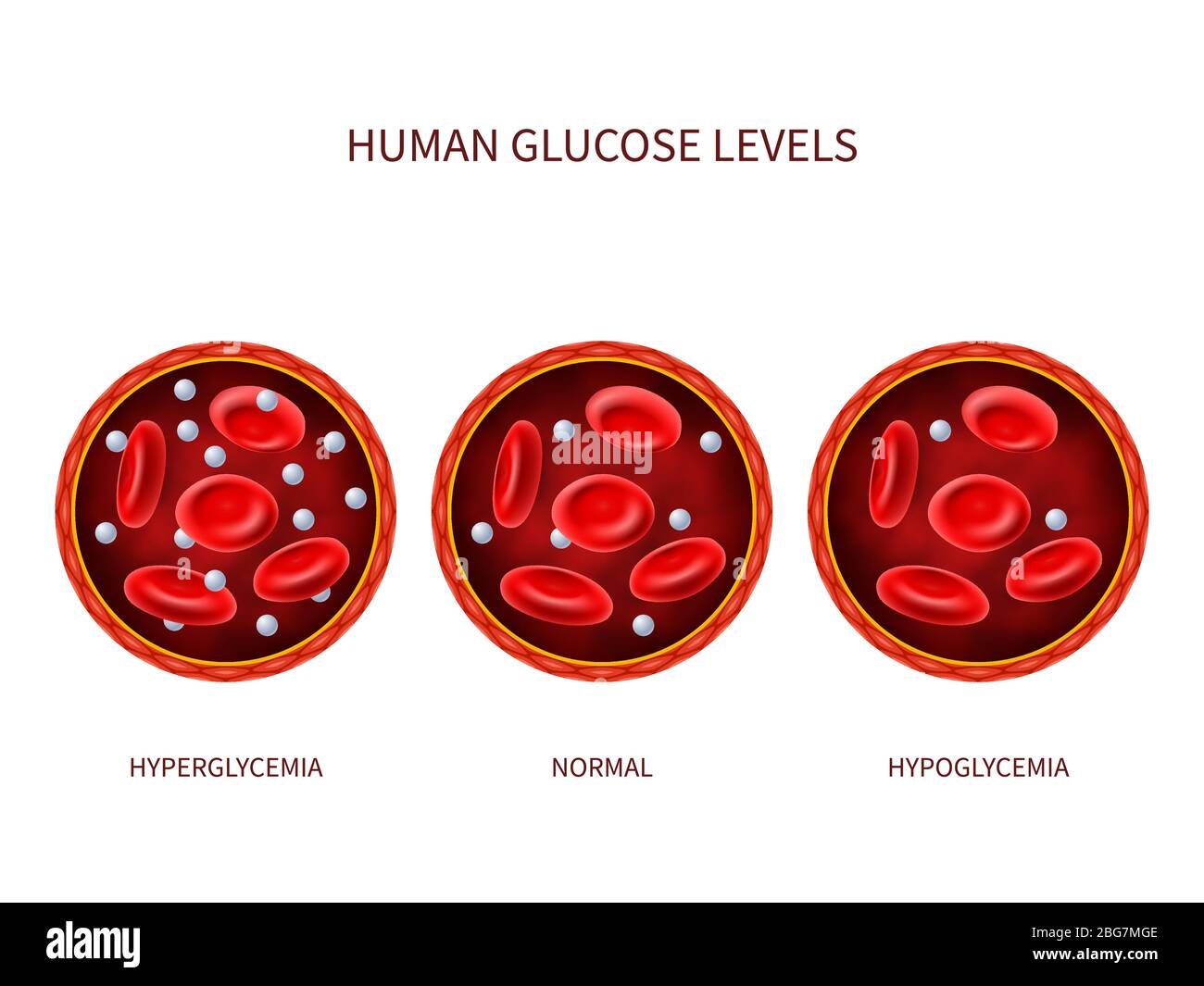 Livelli di glucosio nell'uomo iperglicemia, normale, ipoglicemia. Diagramma vettoriale ematologico con vaso sanguigno, eritrociti e zucchero. Illustrazione di diabeti Illustrazione Vettoriale