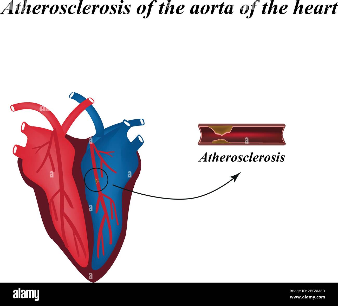Aterosclerosi delle arterie del cuore. Infografica. Illustrazione vettoriale Illustrazione Vettoriale