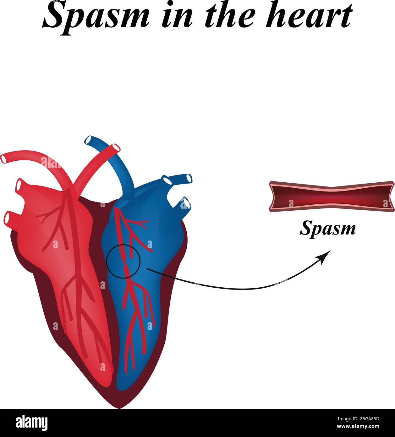 Spasmo delle arterie del cuore. Infografica. Illustrazione vettoriale Illustrazione Vettoriale