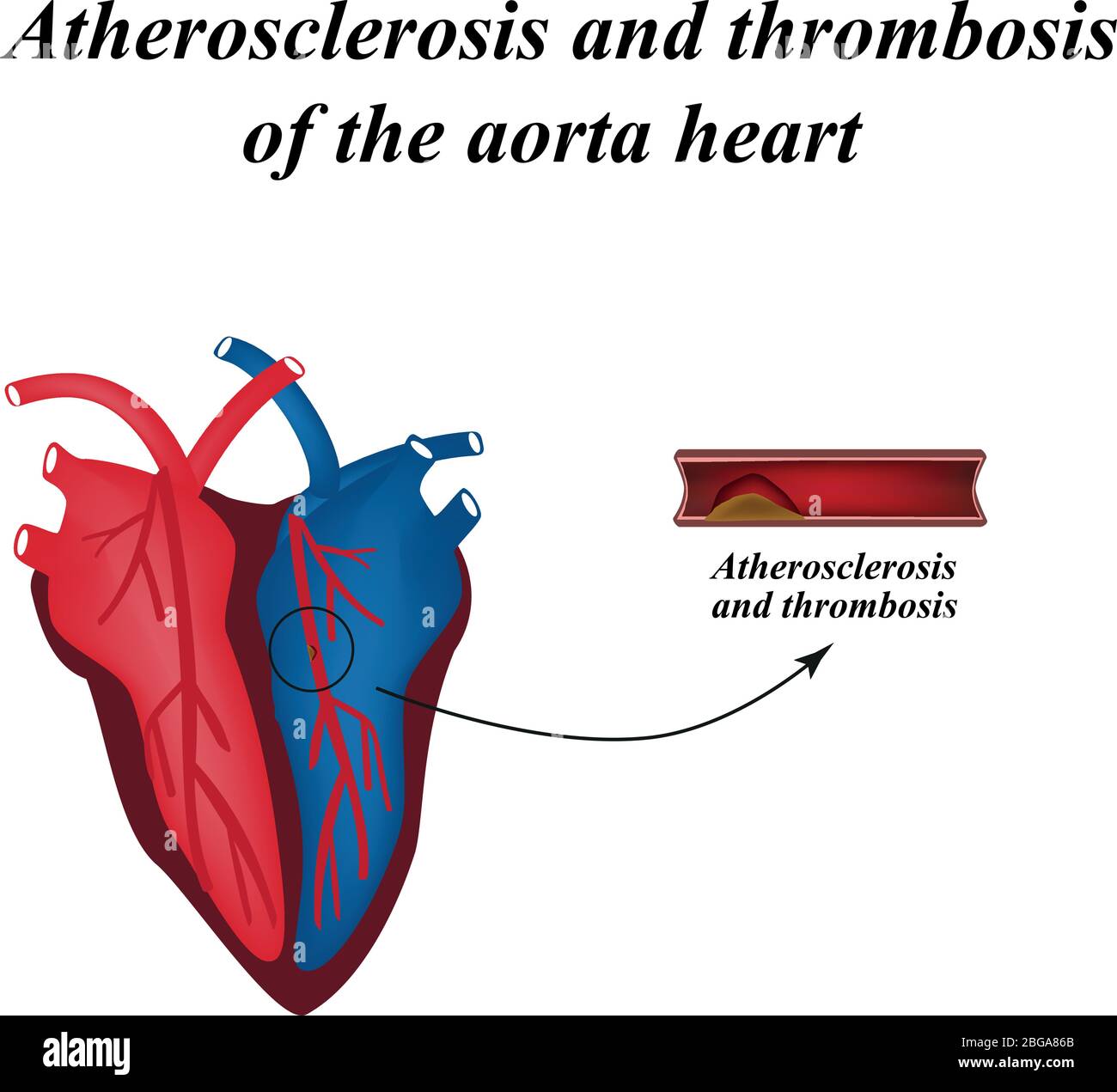 Aterosclerosi e trombosi delle arterie del cuore. Infografica. Illustrazione vettoriale Illustrazione Vettoriale