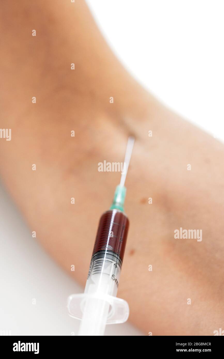 siringa nel braccio paziente prelievo di campioni di sangue per l'analisi del sangue Foto Stock