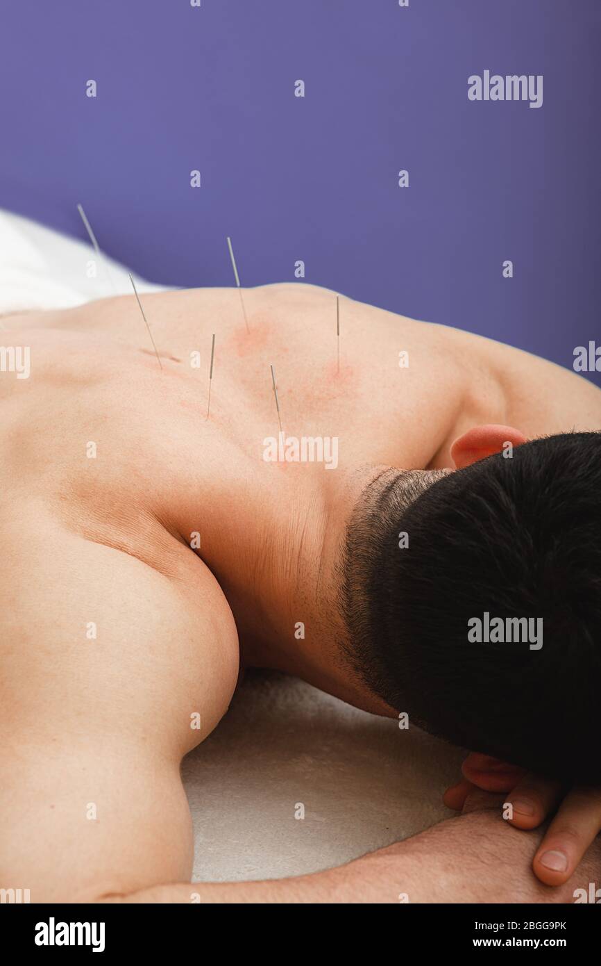 L'uomo con aghi di agopuntura nella schiena sta ricevendo un trattamento in una clinica tradizionale cinese di medicina. Primo piano degli aghi su sfondo blu Foto Stock