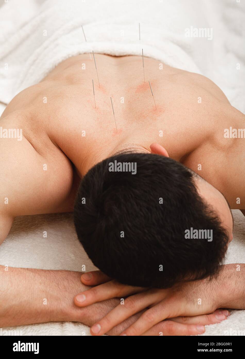 L'uomo con aghi di agopuntura nella schiena sta ricevendo un trattamento in una clinica tradizionale cinese di medicina. Primo piano degli aghi Foto Stock