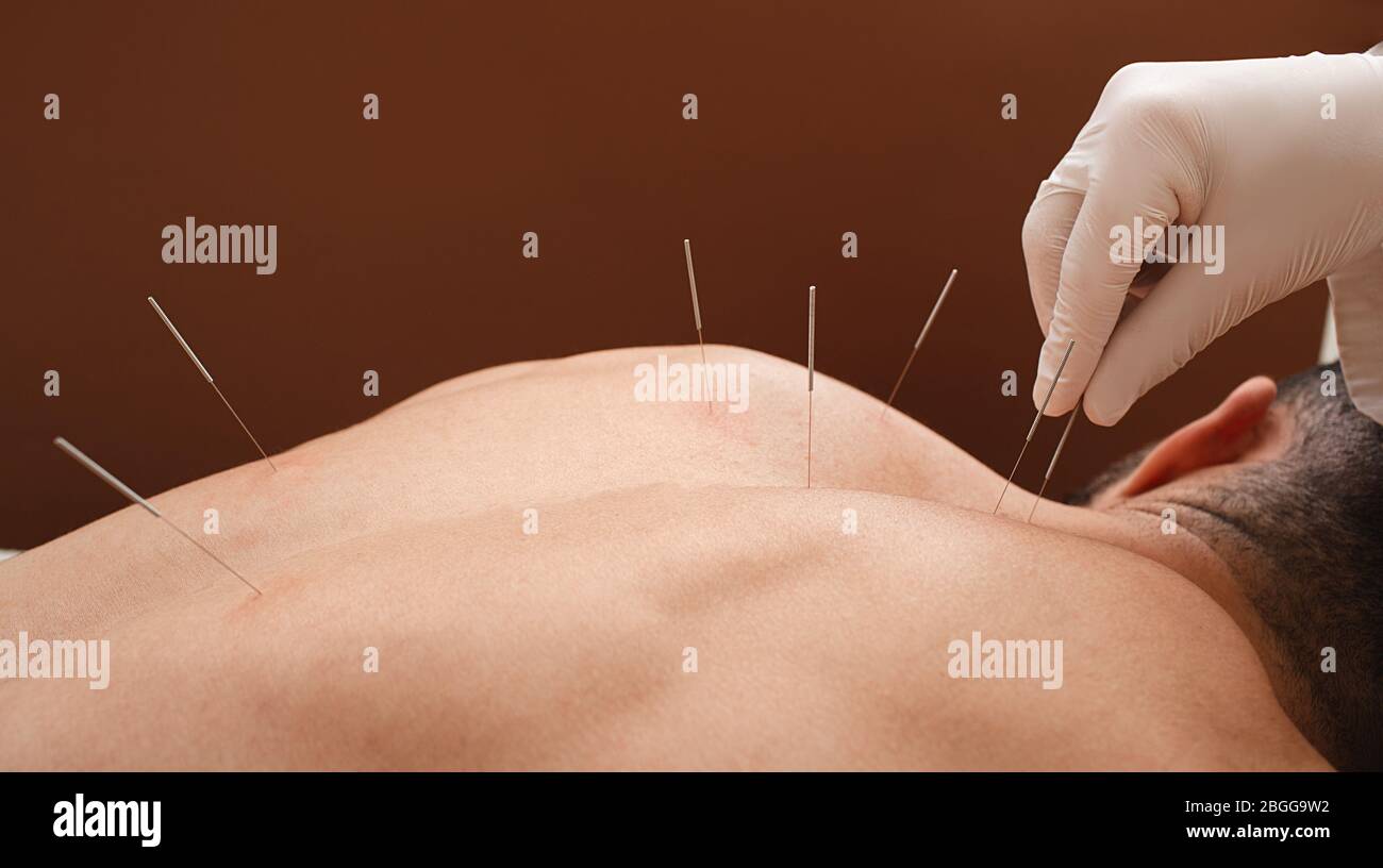 Ago di primo piano sul retro dell'uomo durante la procedura di agopuntura su sfondo marrone. Agopuntura. Macro Foto Stock