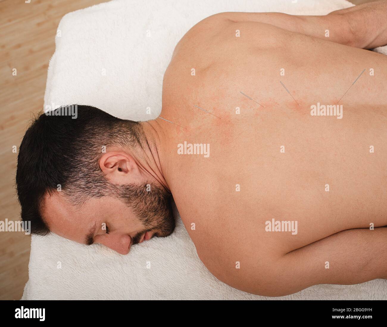 Maschio durante la procedura di agopuntura spinale. Agopuntura spinale per ernias intervertebrali e protrusioni Foto Stock