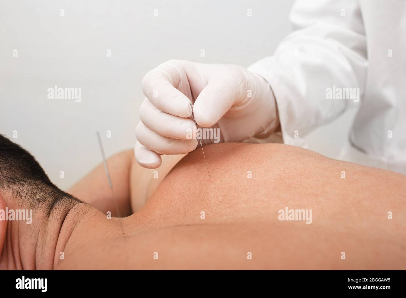 Mano dell'agopuncturista con ago per agopuntura. Trattamento con agopuntura del dolore cronico alla schiena maschile Foto Stock