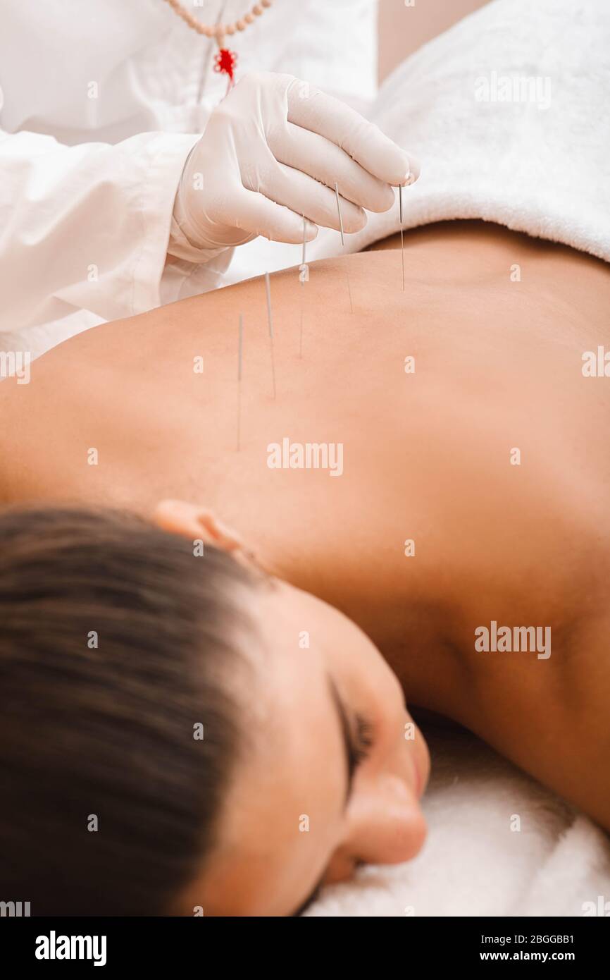 Trattamento del sistema muscoloscheletrico di una donna con una procedura di agopuntura in una clinica. Aghi lungo la spina dorsale di una donna primo piano Foto Stock