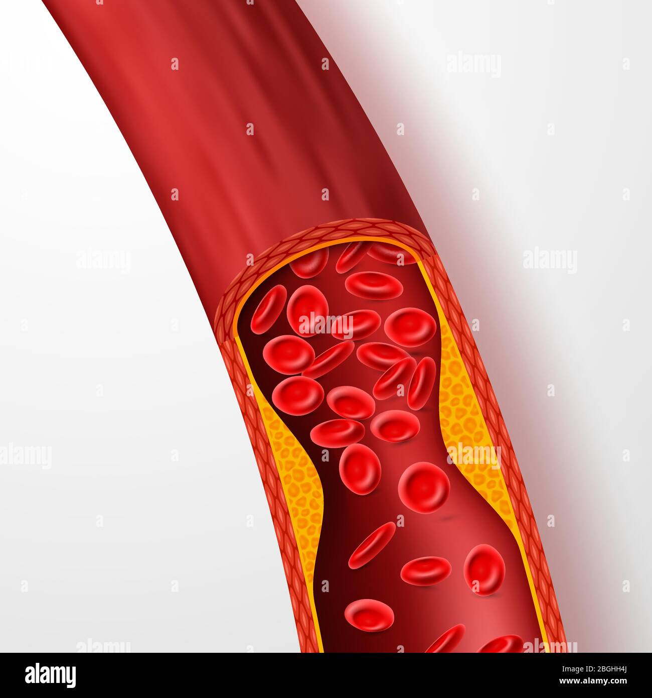 Vaso sanguigno bloccato, arteria con trombi di colesterolo. illustrazione vettoriale della vena 3d con coagulo. Sangue arterioso medico, malattia da colesterolo, circolazione di flusso bloccata Illustrazione Vettoriale