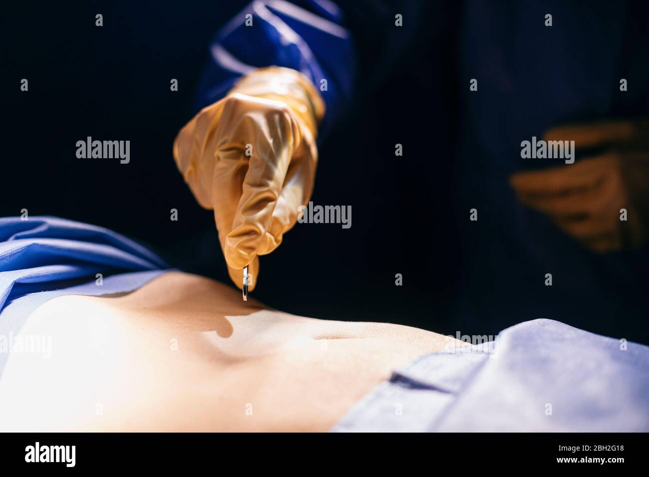 Primo piano del chirurgo che fa un incicione durante un'operazione Foto Stock