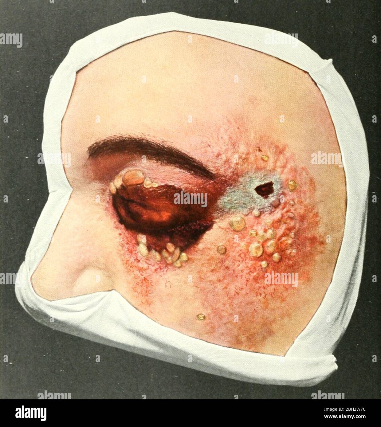 Illustrazione dal libro 'Atlante della Chirurgia Clinica' di Philipp Bockenheimer, che presenta una regione del tempio e dell'occhio del viso colpito dall'antrace, pubblicato da Rebman Co, 1908. Archivio Internet di cortesia. () Foto Stock