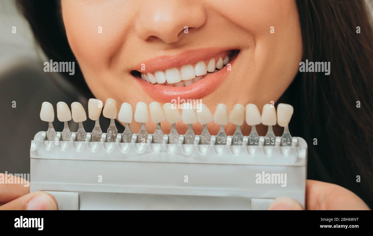 tavolozza denti con diverse sfumature di denti vicino femmina sorridente. Stomatologia, sbiancamento dei denti, impianto dentale Foto Stock