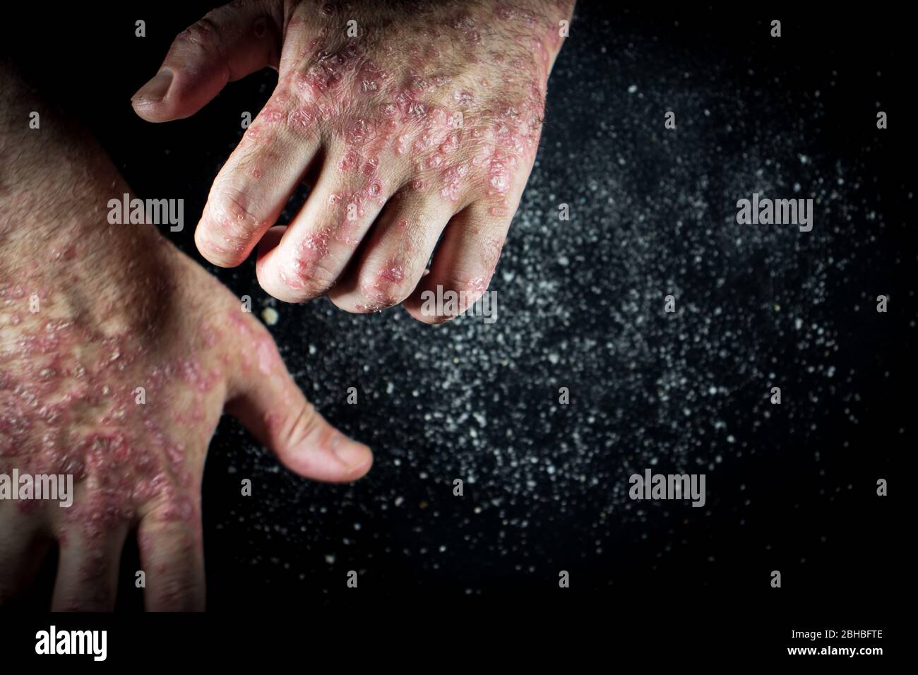 Psoriasi (eczema) sulla mano l'uomo prurito pelle le scale di psoriasi sono sparse su sfondo nero Foto Stock