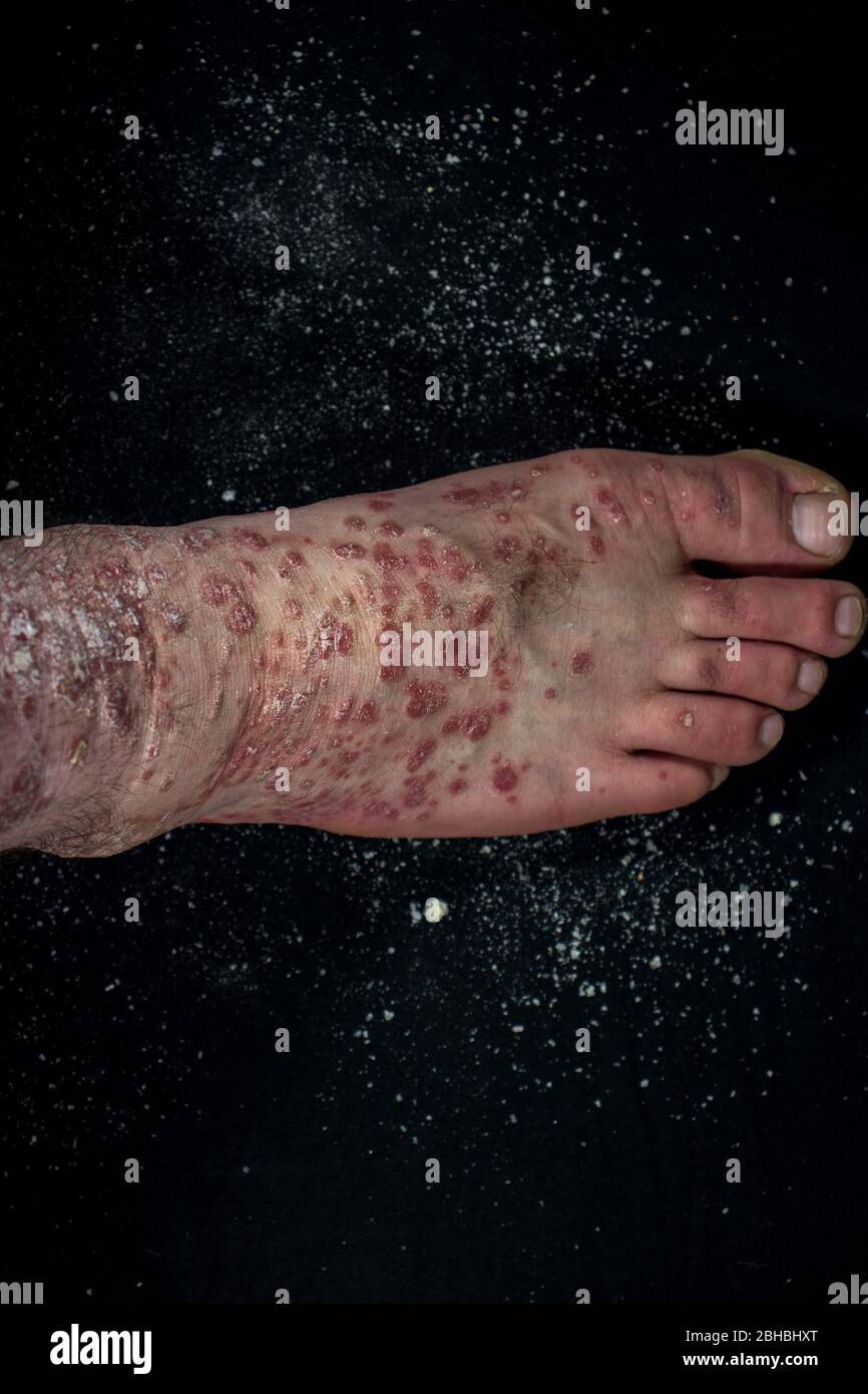 Psoriasi (eczema) sul piede l'uomo prurito pelle le scale psoriasi sono sparse su sfondo nero Foto Stock