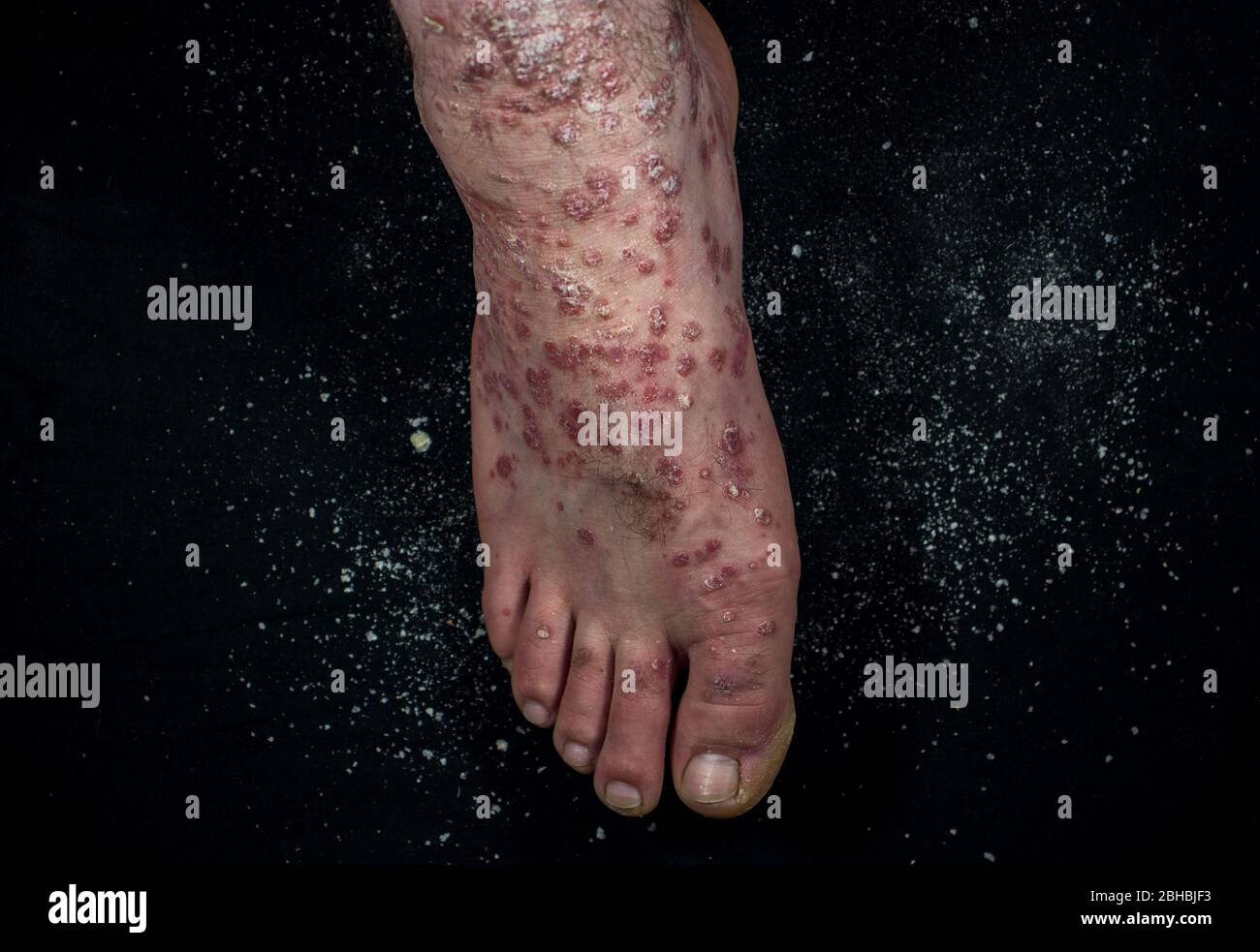 Psoriasi (eczema) sul piede l'uomo prurito pelle le scale psoriasi sono sparse su sfondo nero Foto Stock