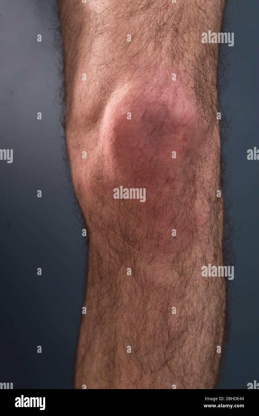 Il ginocchio peloso è su uno sfondo scuro. Concetto medico. Dolore al ginocchio gonfio. Foto Stock